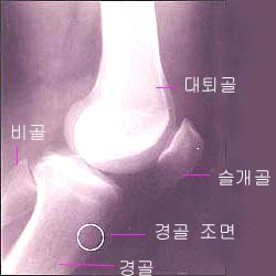 tibial_tuberosity_1s.jpg