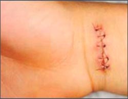 laceration_finger2-suture_1-02s.jpg