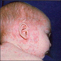 measles_1.jpg