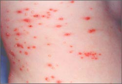 chickenpox-stoch-16s.jpg