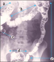 barium-enema-9s.jpg