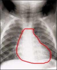 x_ray_lungs_heart_2s.jpg