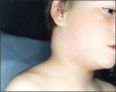 lymphadenitis-neck-1s.jpg