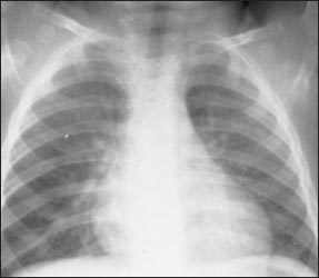chest-x-ray-2s.jpg