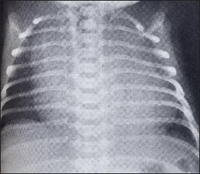 chest-x-ray-1s.jpg