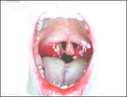 tonsillitis_2-11s.jpg