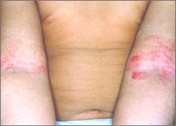eczema_arms-8s.jpg