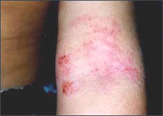 eczema_arm-2-1s.jpg