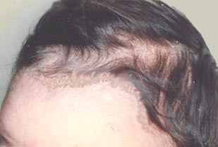 psoriasis-scalp-1s.jpg