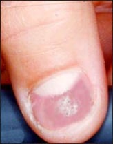 psoriasis-nail-1s.jpg