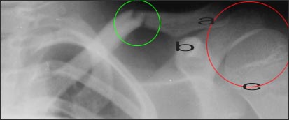 ltclavicularfracture.jpg