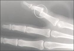 finger__fracture_dislocation-1-01s.jpg