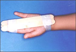 hand_bone_fracture_finger_bumock-1s.jpg