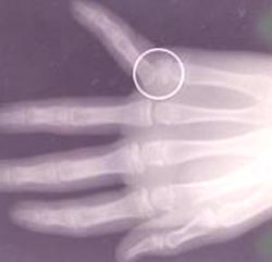 hand_bone_fracture_finger-01s.jpg