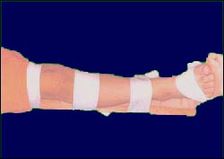 tibia_fracture_splint_1_2s.jpg