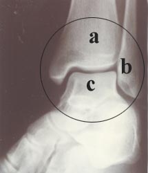 ankle_joint-3s.jpg