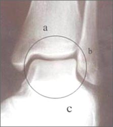 ankle_joint2_1-1s.jpg