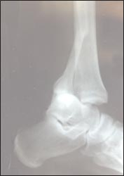 dislocation-ankle-fr-fib-1s.jpg