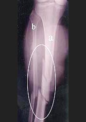 tibia_fibla_fracture_2_1s.jpg