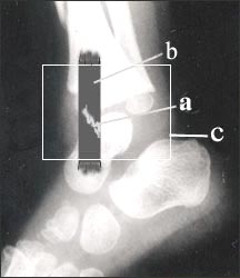 Copy of ankle_joint_3.jpg