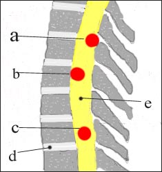 spinal cord-tumor-1s.jpg
