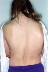 scoliosis-backpain.jpg