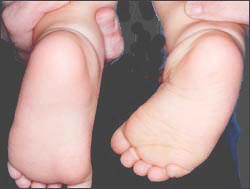 flat_feet_infant _nl_1s.jpg