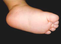 flat_feet_infant _nl_2s.jpg
