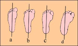 metatarsus-adduction-1sl.jpg