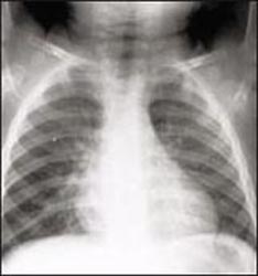 chest_x_ray_bronchiolitis_s-16.jpg