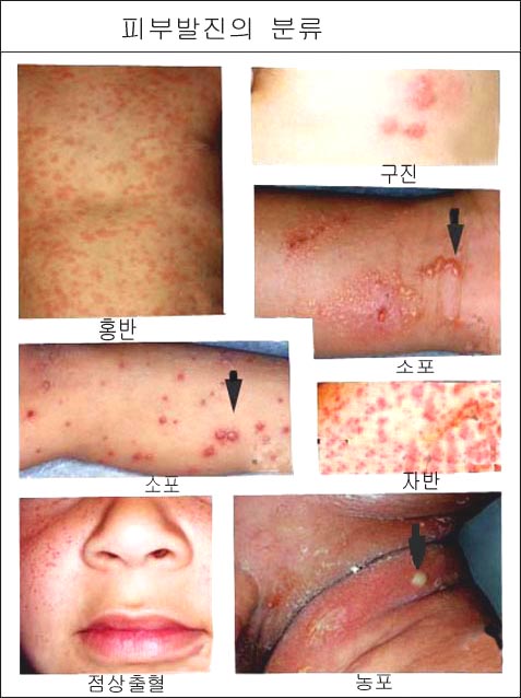 skin-rash-1s.jpg