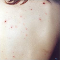 chickenpox-17-3s.jpg
