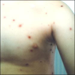 chickenpox-17-2s.jpg