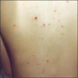 chickenpox-17-4s.jpg