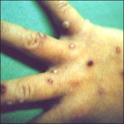 chickenpox-17-1s.jpg