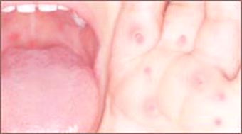 hand-foot_mouth_disease3_1s.jpg