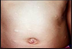 chickenpox-scar-17-1s.jpg
