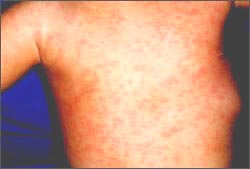 drug_allergy_skin_rash_3s.jpg