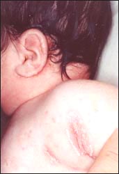 eczema_face_9s.jpg