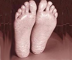 eczema_feet_2-17s.jpg