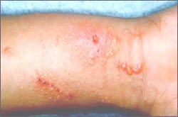 ivy-dermatitis-arm-1-1s (1).jpg