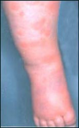 urticaria4_drug-2s.jpg