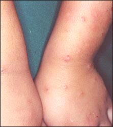insect_ bite_dermatitis1_s.jpg