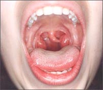 tonsillitis_6-1s.jpg