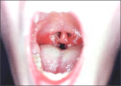 tonsillitis_acute-str-1s.jpg