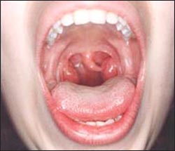 tonsillitis_6-8s.jpg