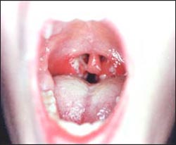 tonsillitis_acute-str-1-8s.jpg