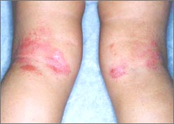 eczema_legs-7.jpg