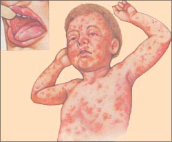 measles_s.jpg