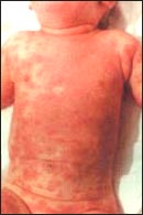kawasaki disease-rashes_s.jpg
